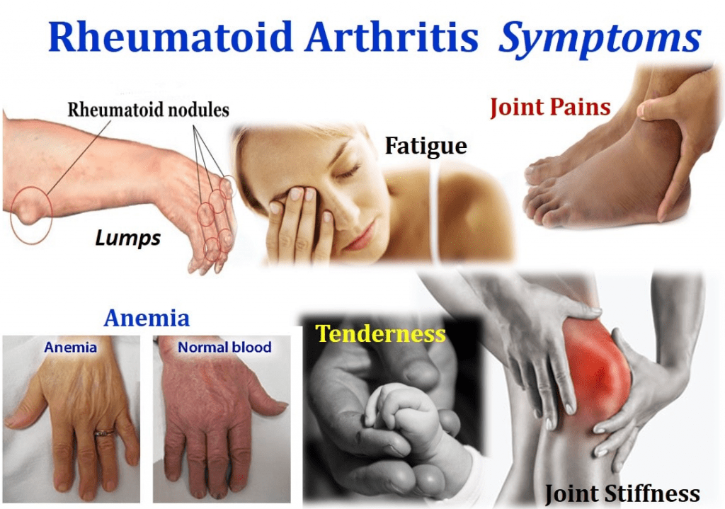 Arthritis Most Painful Types Of Arthritis Cause Symptoms Treatments